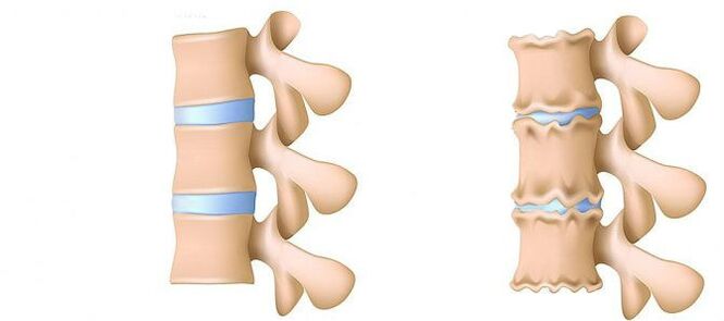 Osteochondrosis bederní oblasti