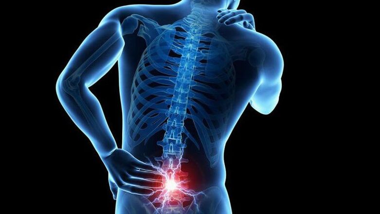 Příznaky bederní osteochondózy